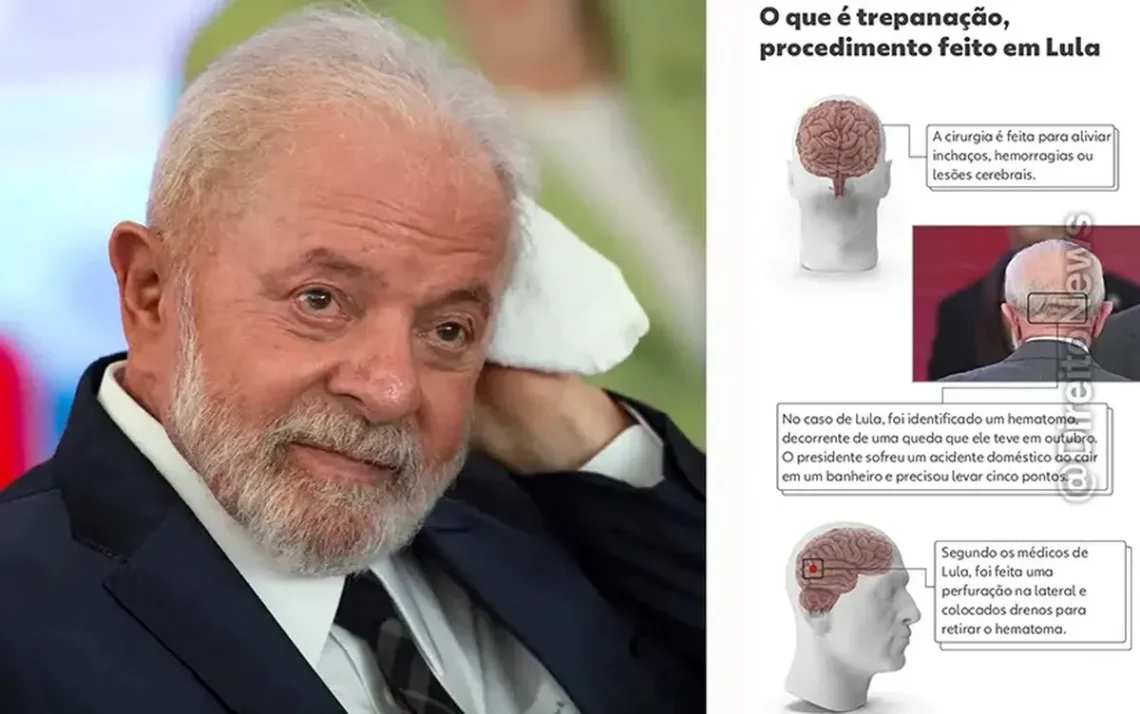 Hemorragia, Enchimento, de líquido, no cérebro, Sangramento, cerebral, Sangue, dentro, do cérebro, Acidente, vascular, cerebral hemorrágico;