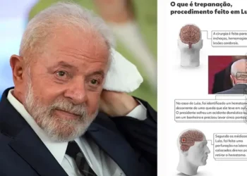 Hemorragia, Enchimento, de líquido, no cérebro, Sangramento, cerebral, Sangue, dentro, do cérebro, Acidente, vascular, cerebral hemorrágico;